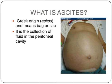 Approach To A Patient With Ascites