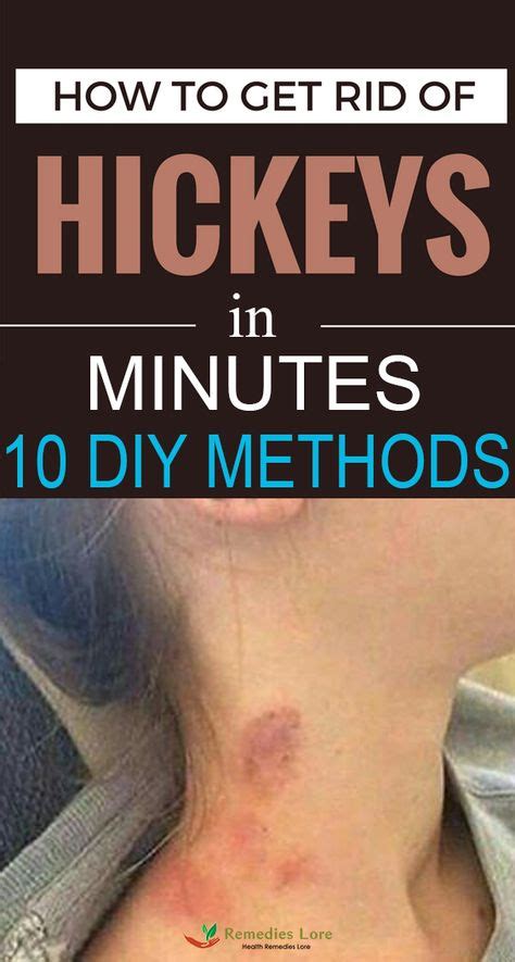 how to get rid of hickey in minutes 10 diy methods how