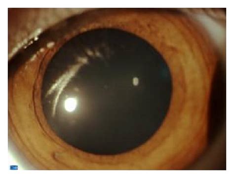 the hereditary hyperferritinemia cataract syndrome in 2 italian families