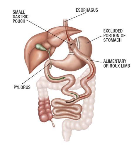 Gastric Bypass Roux En Y Surgery Lehigh Valley Health Network
