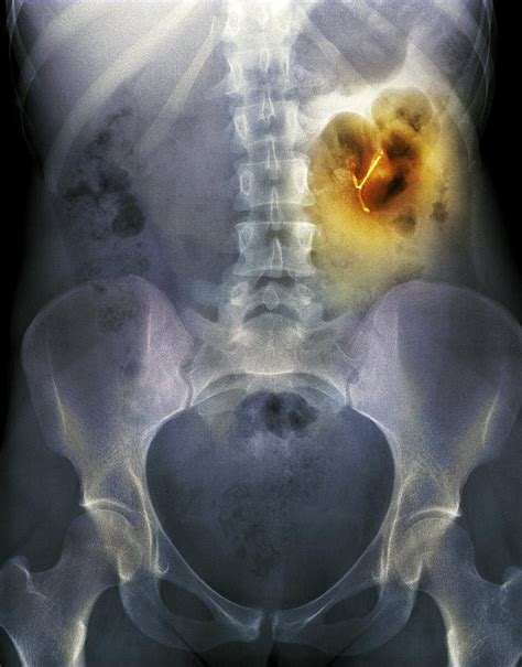 Ectopic Iud Contraceptive X Ray Photograph By Du Cane Medical Imaging