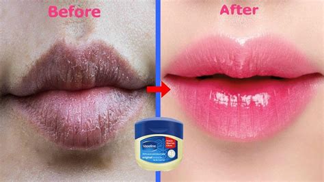 proven ways to get rid of dark lips permanently how to remove dark