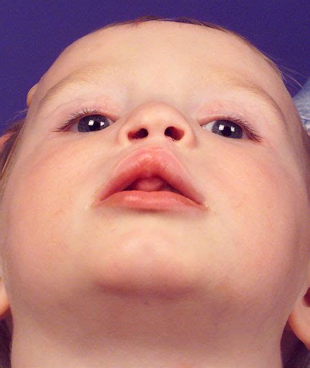 Pediatric Bilateral Cleft Lip