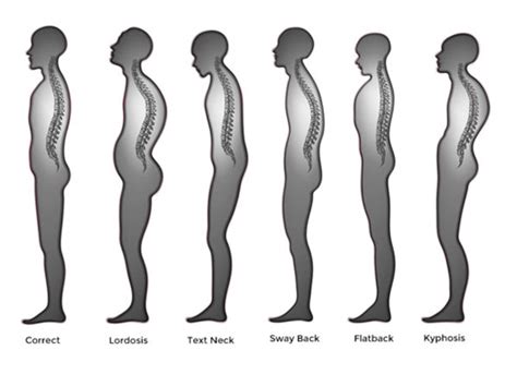 fix kyphosis dump  circuscom