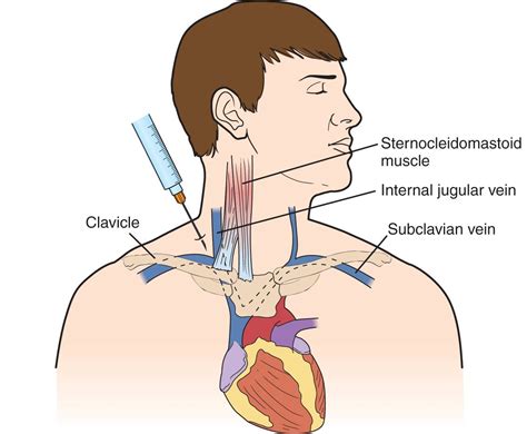 central venous  placement internal jugular vein subclavian vein