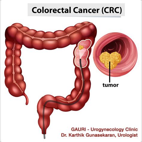 What Symptoms For Colon Cancer Colon Cancer Diagnosis And Treatment