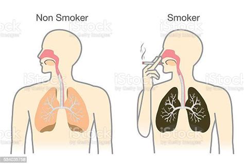 comparison between lung of smoker and non smoker stock illustration