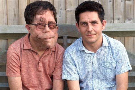 agony of identical twins born with rare genetic disease that has left one of them with huge