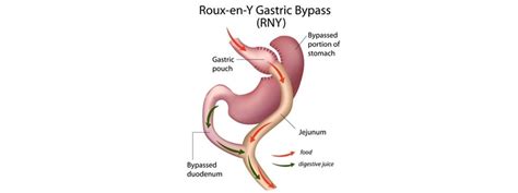 Gastric Bypass Melbourne Weight Loss Surgeon