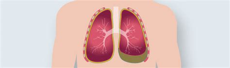 Pleural Effusion And Ascites Pfm Medical Ag