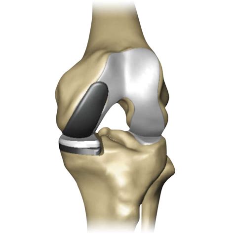 knee replacement surgery  joint replacement center  texas health
