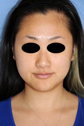 Asian Double Eyelid Images Healing Diary Seattle Bellevue