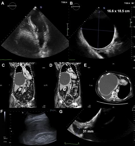 giant hepatic cyst  rare   syncope canadian journal