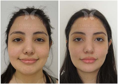 cheek reduction gallery the plastic surgery clinic