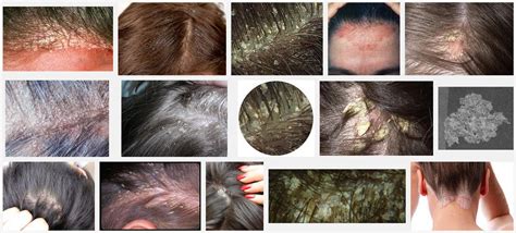 natural dandruff recipes  avoid  side effect  cosmetic chemicals
