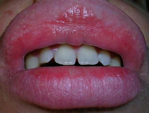 re just to clarify peeling lips exfoliative cheilitis 9 5 2012 1981995