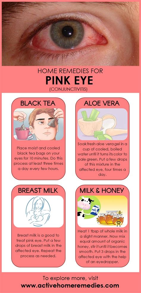 home remedies  pink eye conjunctivitis active home remedies