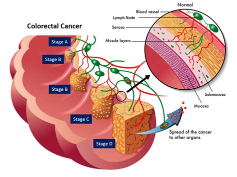 Biomarker Discovery Offers Clearer Prognosis For Bowel And Rectal