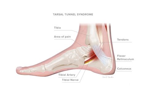 tarsal tunnel syndrome kevinroot medical