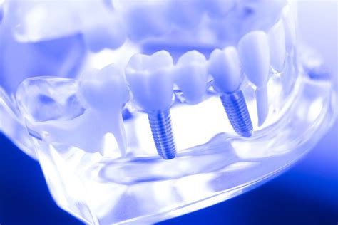 average cost   single tooth implant dental implant tx