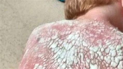mother s anger after sons get horrific second and third degree burns