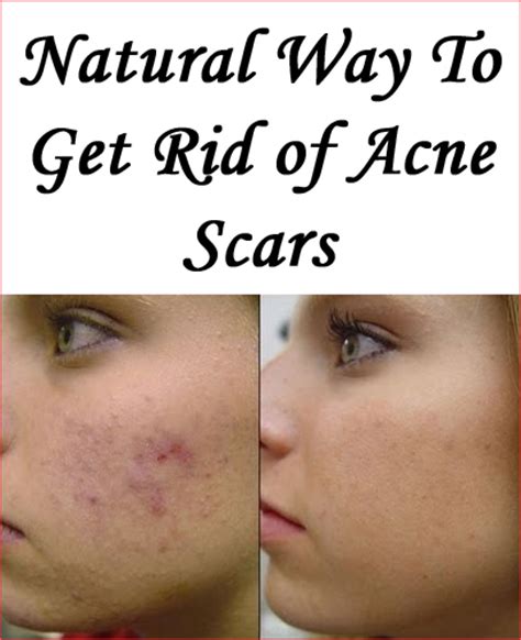 rid  acne scars naturally  acne scar treatment