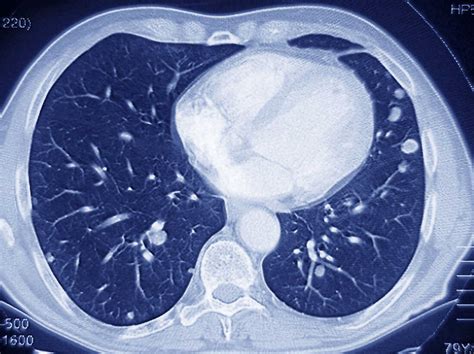 What Does Lung Cancer Look Like In A Ct Scan Ct Scan Machine My Xxx
