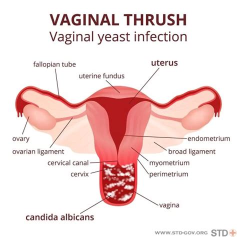 Yeast Infections Natural Remedies Angie S Diary