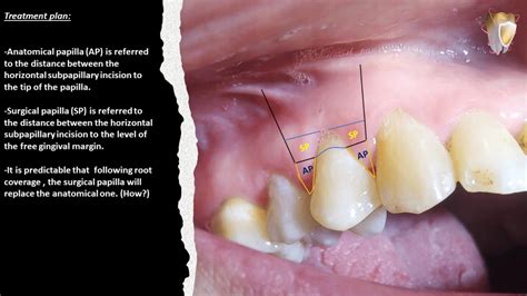 management  single miller class  gingival recession