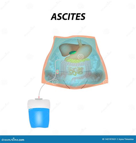 Ascites Vector Illustration 61945594