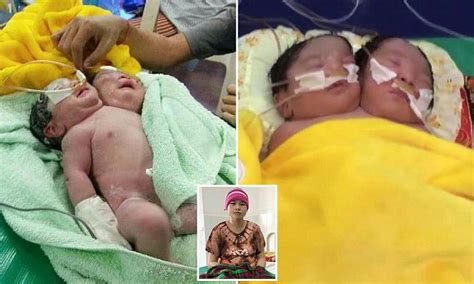 Conjoined Female Twins Have Been Born With One Body And