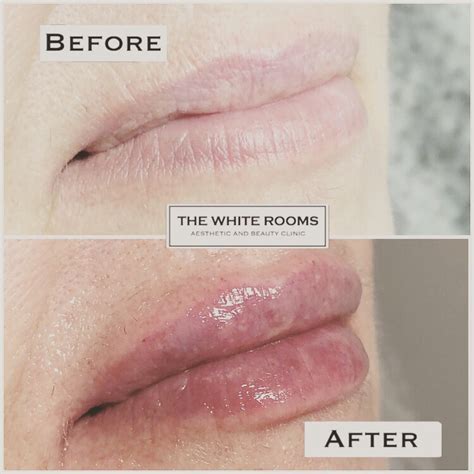 natural lip filler liverpool the white rooms clinic