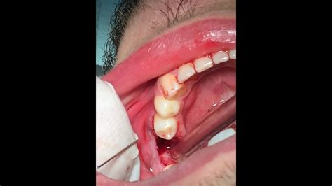 pull  broken tooth  molar extraction klaa jrahy youtube