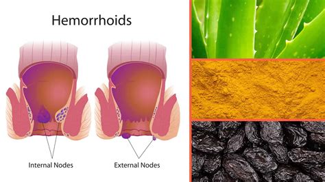 18 foods that can help heal hemorrhoids power of positivity