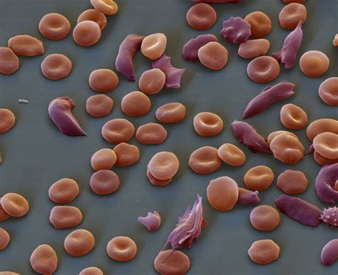 doctors discover  cure   sickle cell anemia