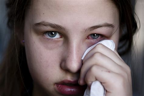 viral pink eye symptoms treatment  prevention eyestyle blog