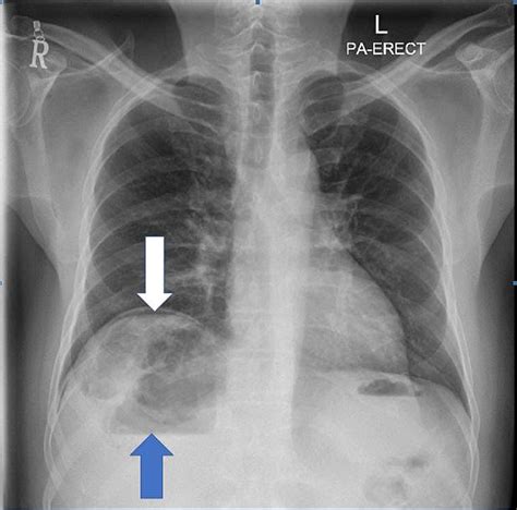 cureus gas  diaphragm  rare case  ruptured liver abscess