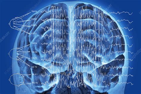 Brain And Brain Waves In Epilepsy Stock Image M150 0282 Science