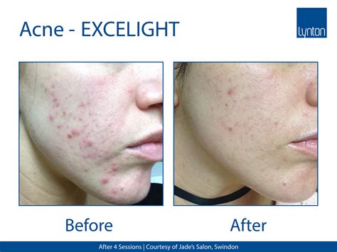 acne treatment jh skincare clinic ipl laser  dermalux led  redness red veins rosacea
