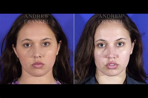 buccal fat removal  beverly hills ca andrew frankel md
