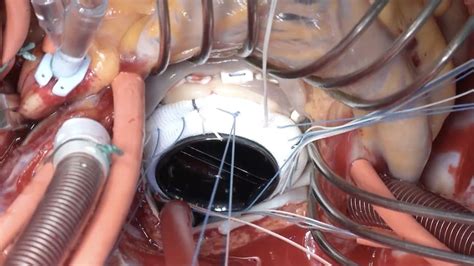 On X Mitral Valve Mv Replacement Cryolife