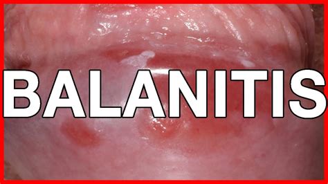 Balanitis Home Remedy And Natural Cures