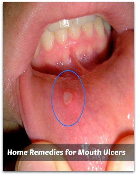 Do Cat Mouth Ulcers Go Away On Their Own Nonpareil Vodcast Lightbox