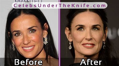 Demi Moore Before After Plastic Surgery Pics Inside