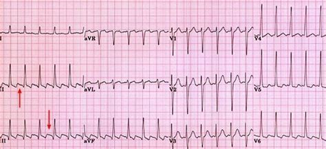 Atrial Flutter