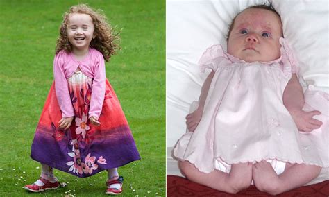 five year old girl born with legs like a frog takes first steps and is looking forward to