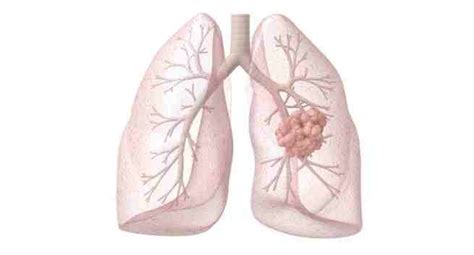 8 Common Signs And Symptoms Of Lung Cancer You Need To Know Read