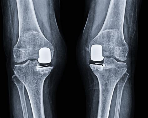 partial knee replacement adam sassoon md ms