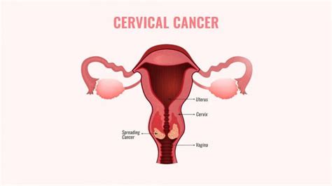Cervical Screening Pap Smear And Colposcopy Dtap Clinic