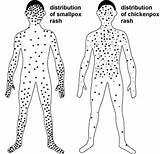 Smallpox Rash Chickenpox Distribution Do Someone If Has Vaccine Who Determine sketch template